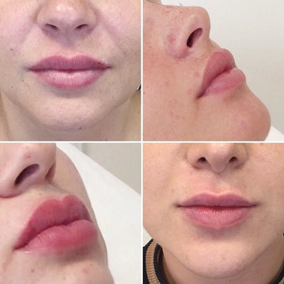Dr Harris’ Nonsurgical Lip Lift (NLL)